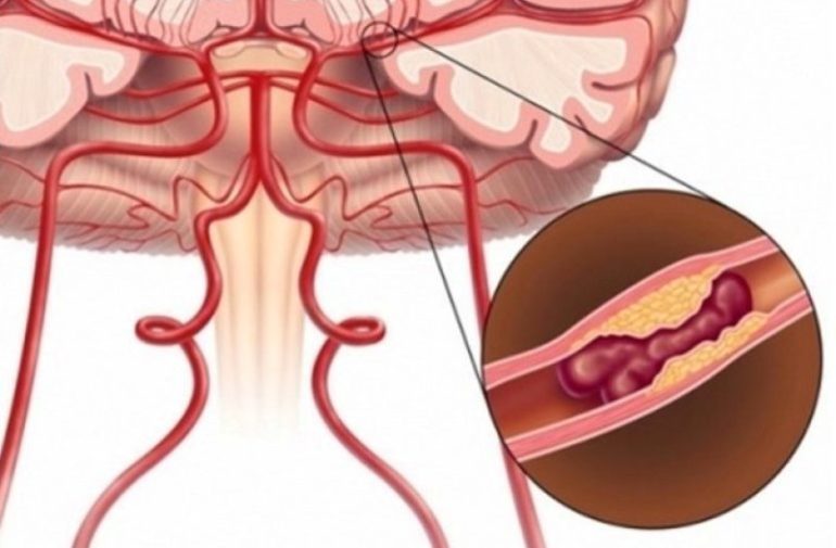 Медикаментозное лечение микроинсульта