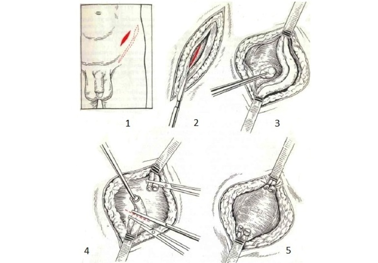 Методика Иваниссевича