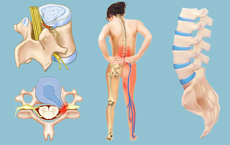 Межпозвоночная грыжа