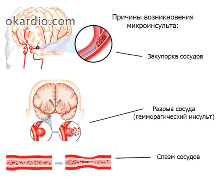 Микро инсульт как проявляется