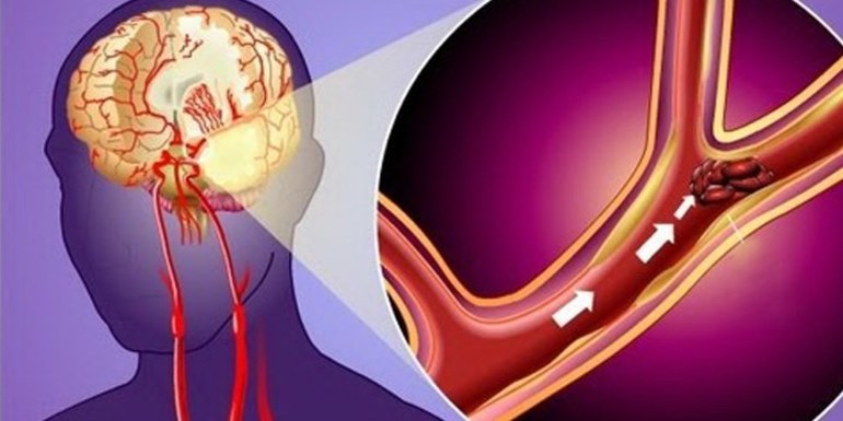 Микроинсульт