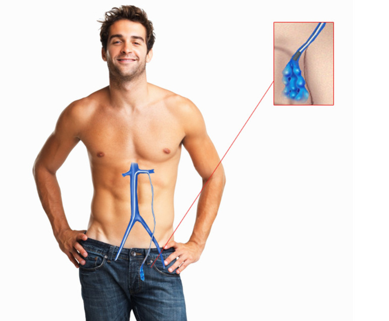 Мужская болезнь варикоцеле