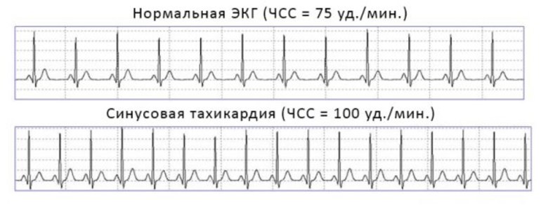Нарушение ритма сердца