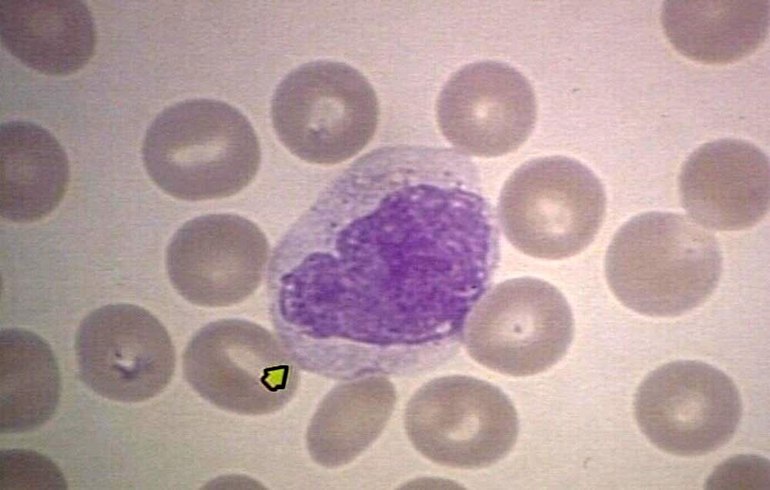 Недостаток моноцитов