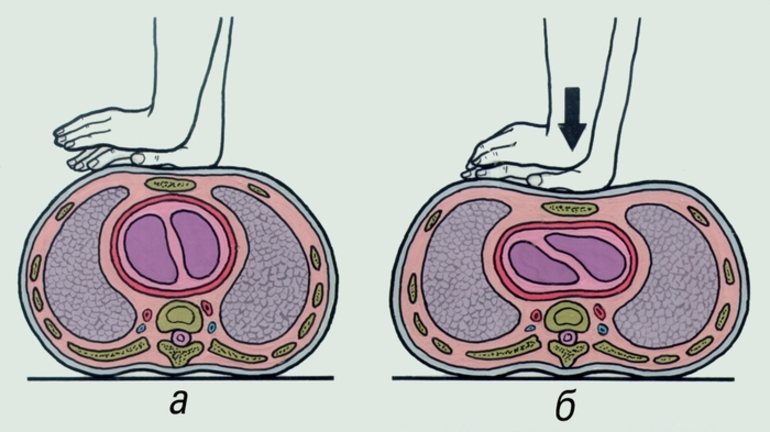Непрямой массаж сердца