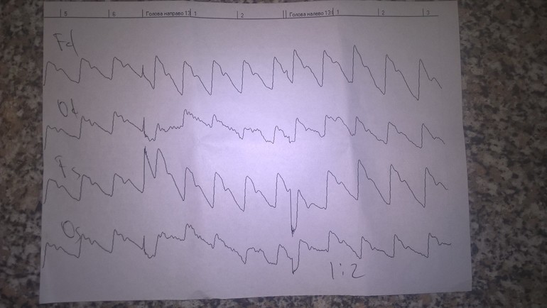 Нормы результатов РЭГ