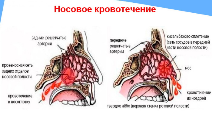 nosovoe-krovotecjenie