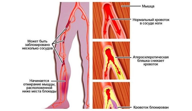 Облитерирующий атеросклероз нижних конечностей