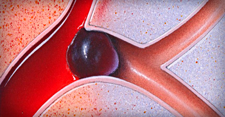 Образование тромбов