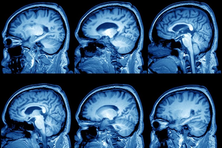 Обследование головного мозга