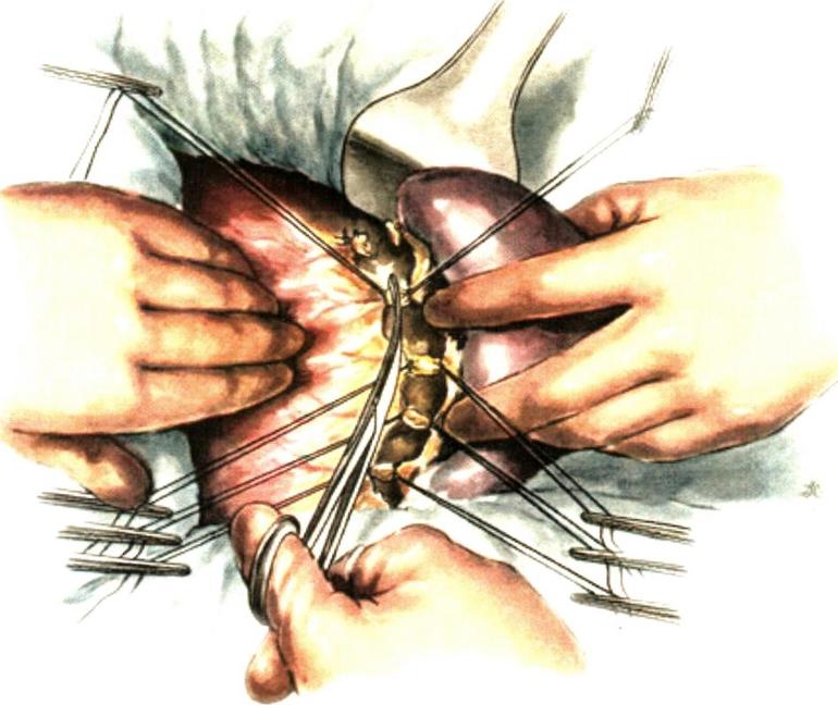 Оперативное вмешательство при гемолитической анемии