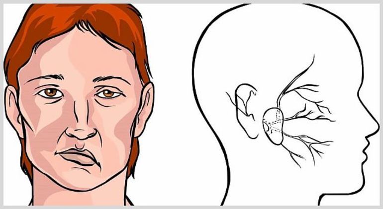 Как определить микроинсульт