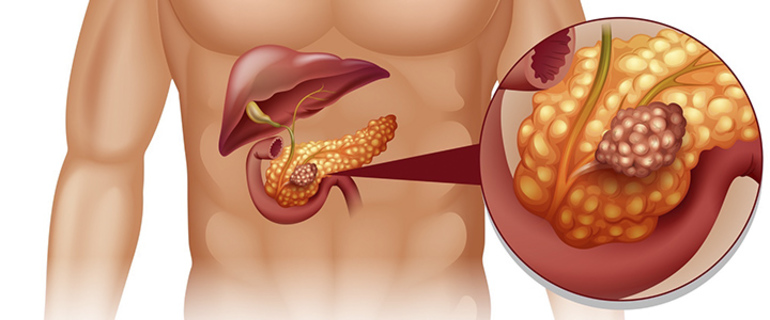 Опухоль в просвете железы.