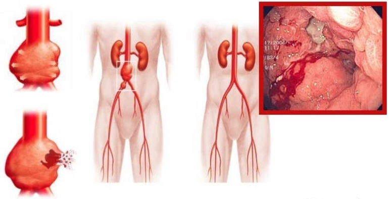 Как остановить артериальное кровотечение