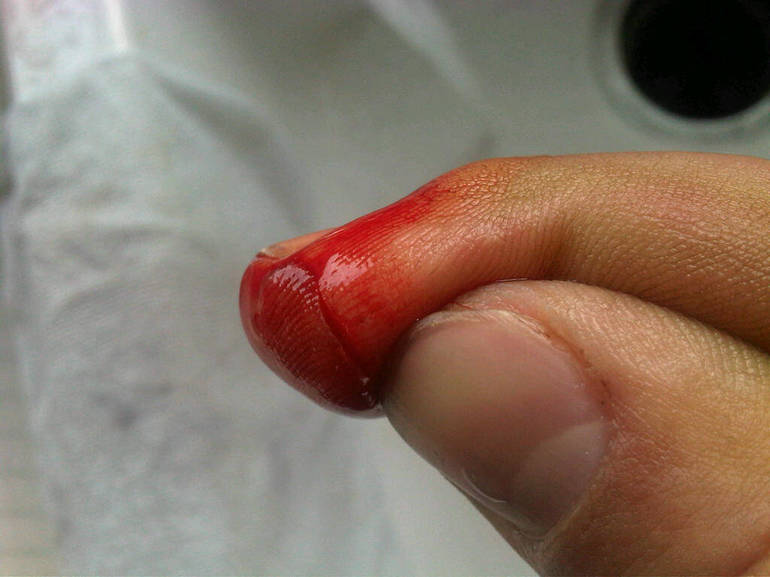 Как остановить кровь из раны