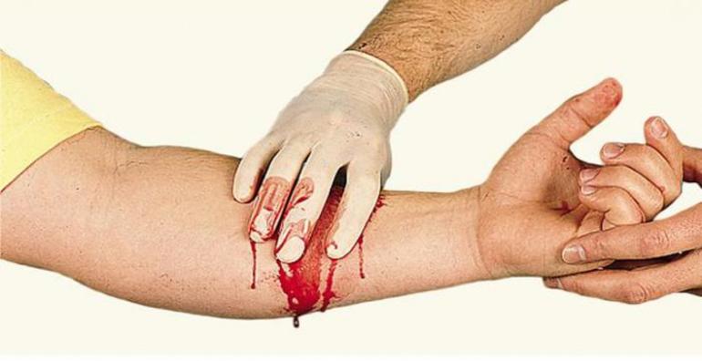 Как остановить венозную кровь