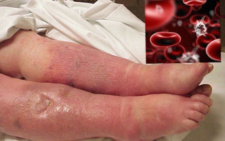 Острый сепсис