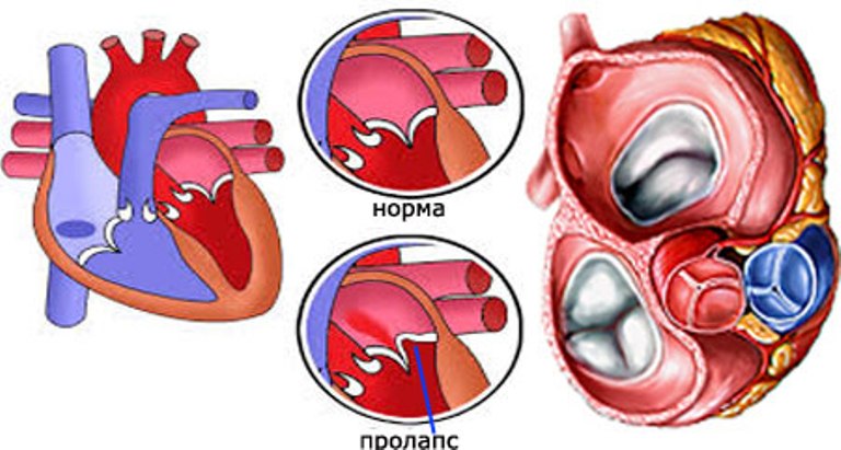 Пролапс митрального клапана