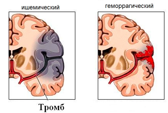 виды инсульта
