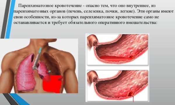 parenhimatoznoe krovotechenie