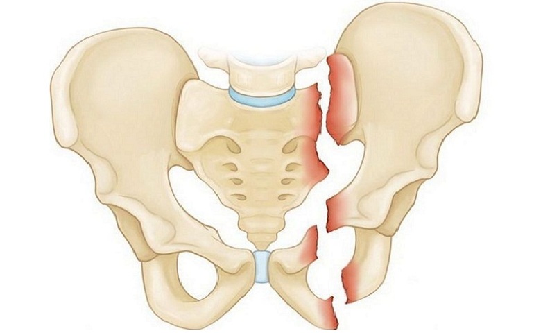Переломы костей