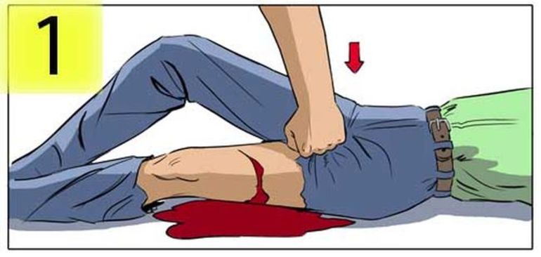 Как пережать артерию при кровопотере