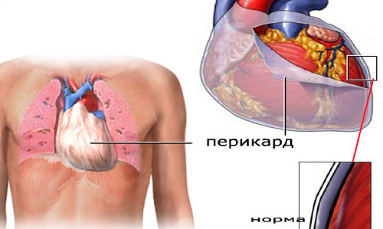 Перикардит
