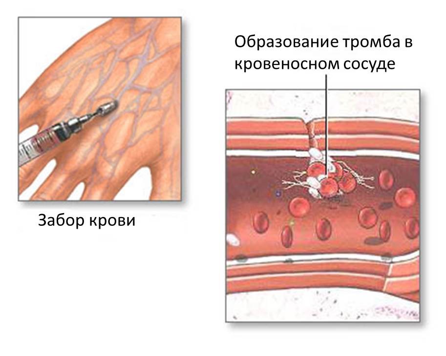 плохо сворачивается кровь