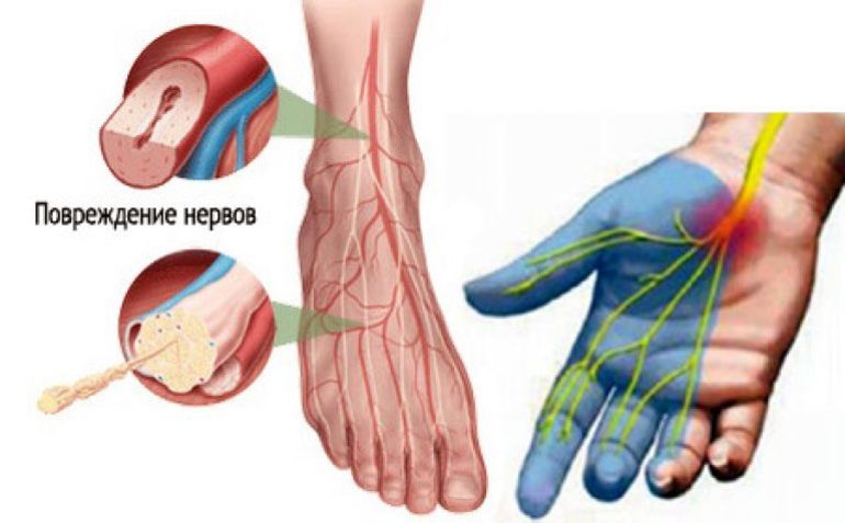 Полинейропатия нижних конечностей симптомы