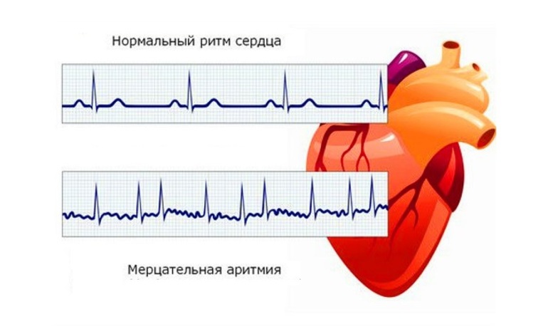 Понятие мерцательной аритмии