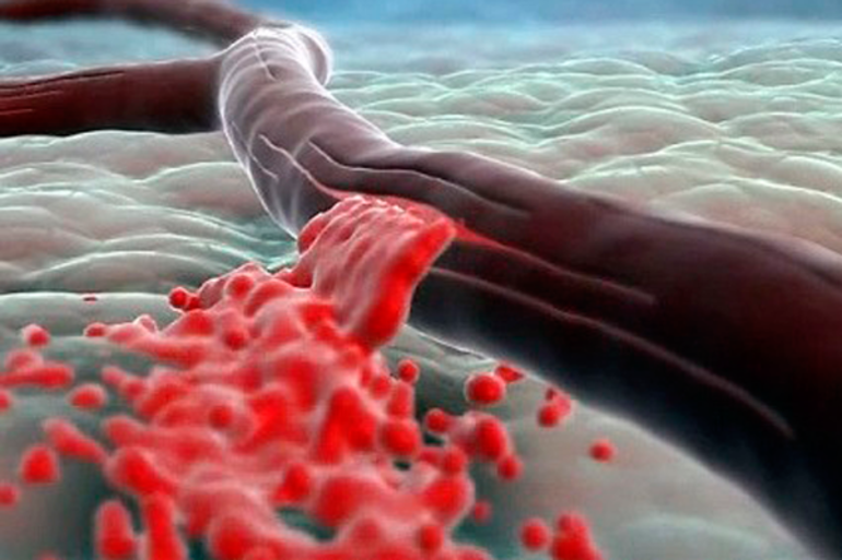 Последствия повышенного фибриноген