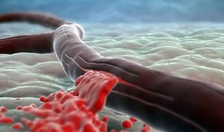 Повреждение сосудов