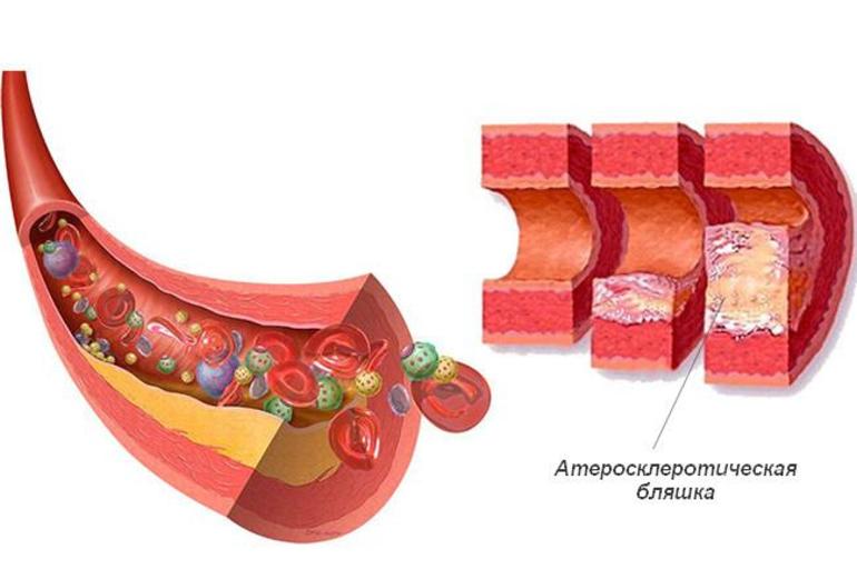 Повышенный холестерин