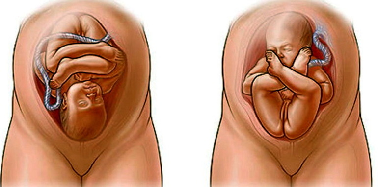 Причины геморрагического шока при беременности
