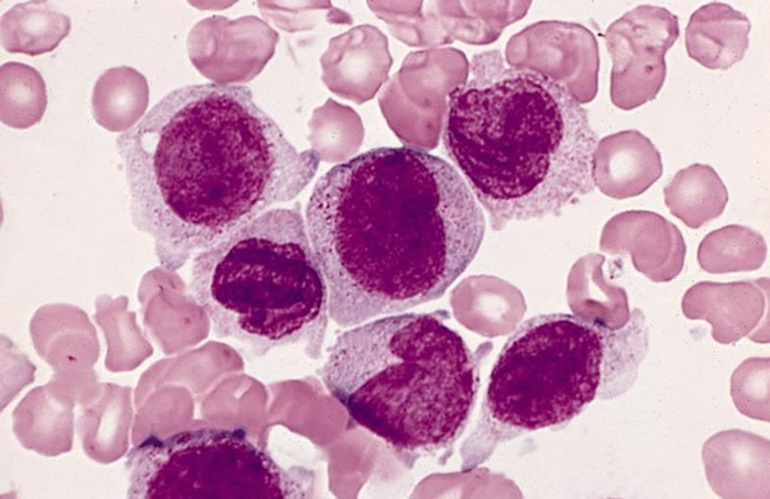 Причины повешения уровня моноцитов