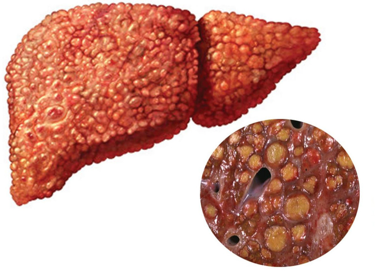 Причины повышенного глазного давления