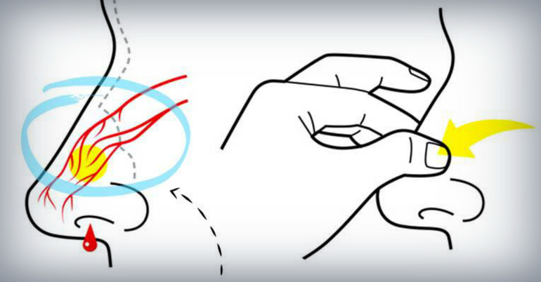 Причины появления крови из носа