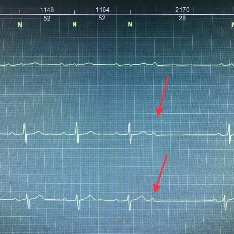 Причины и симптомы экстрасистолии: как лечить нарушение ритма сердца