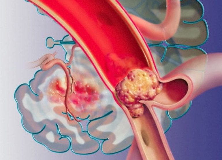 Причины, симптомы и лечение заболеваний сосудов головного мозга
