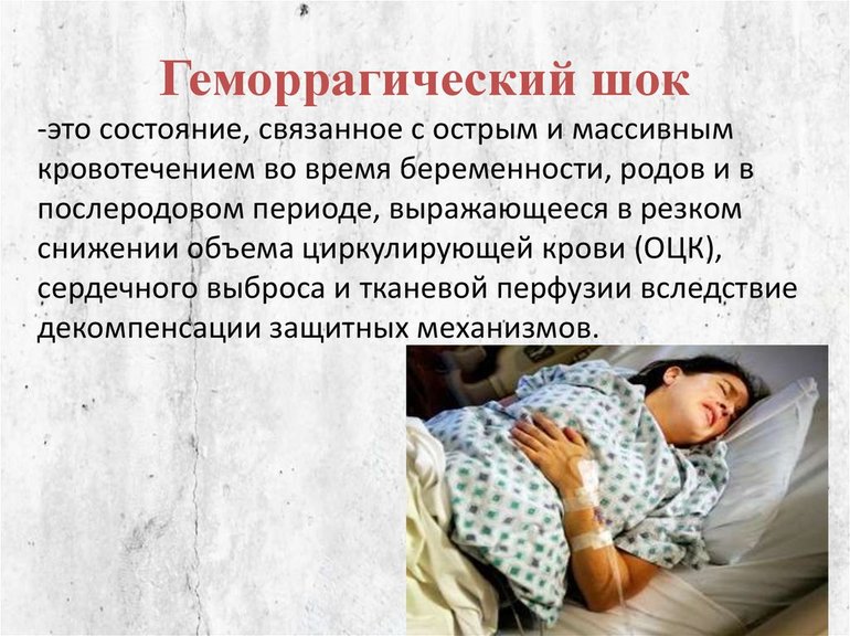 Причины возникновения геморрагического шока у беременных