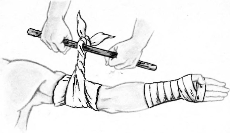 Применение жгута