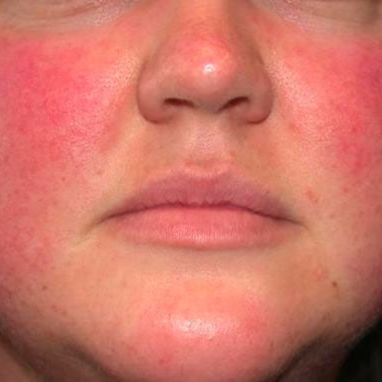 Признаки гиперемии