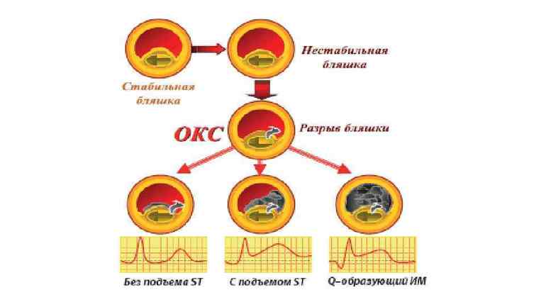 Признаки острого коронарного синдрома