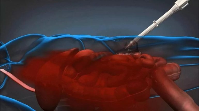 Признаки внутреннего кровотечения в брюшной полости