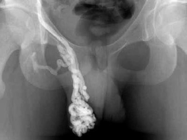 Признаки заболевания варикоцеле