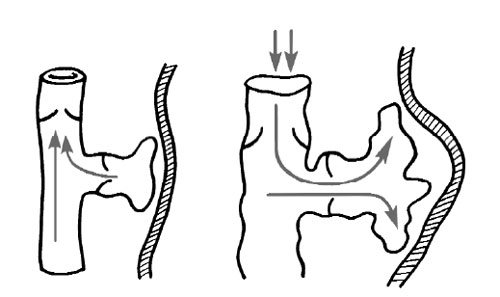 проба Вальсальвы суть метода