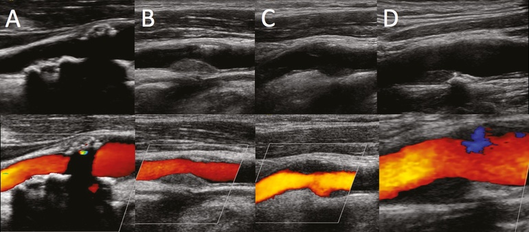 Профилактика атеросклероза сонной артерии