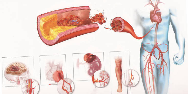 Прогноз лечения кардиосклероза