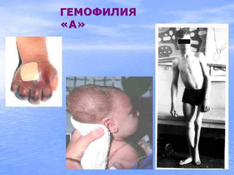 Прогнозы для пациентов с гемофилией