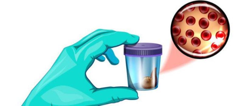 Проведение анализа кала на скрытую кровь и результаты исследования